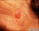 Basal Cell Carcinoma - face