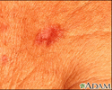 Basal Cell Carcinoma - close-up