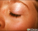 Basal cell nevus syndrome