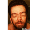 Basal cell nevus syndrome - face