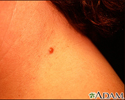 Irritated Seborrheic Kerotosis - neck