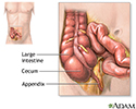 Appendectomy - series