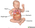 Diaphragmatic hernia repair - series