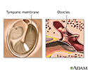 Eardrum repair - series