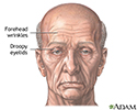 Forehead lift - series