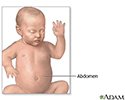 Gastroschisis repair - series