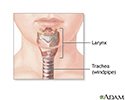 Tracheostomy - series