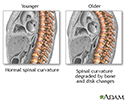 Changes in spine with age