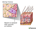 Aged hair follicle