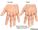 Aging changes in nails