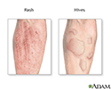 Allergic reactions