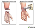 Amputation repair