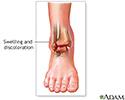 Sprained ankle
