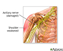 Damaged axillary nerve