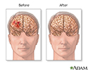Before and after hematoma repair