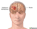 Subdural hematoma