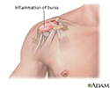 Bursitis of the shoulder