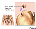 Bone graft harvest