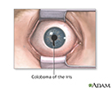 Coloboma of the iris