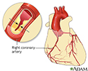 Coronary artery disease