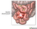Meckel diverticulum