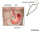 Esophageal manometry