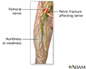 Femoral nerve damage
