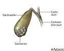 Gallstones