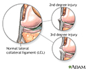 Lateral collateral ligament injury