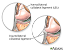 Torn lateral collateral ligament