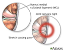 Medial collateral ligament pain