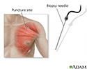 Muscle biopsy