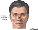 Nasal fracture