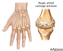 Rheumatoid arthritis