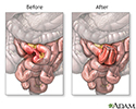 Before and after small intestine anastomosis