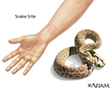 Snake bite
