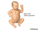 Infant jaundice