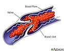 Venous blood clot