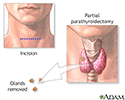 Parathyroidectomy