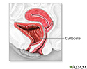 Cystocele