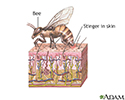 Bee sting