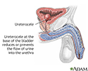 Ureterocele