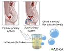 Calcium urine test