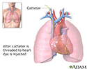 Cardiac catheterization