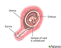 Chorionic villus sampling