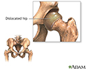 Congenital hip dislocation