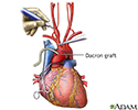 Prosthetic graft placement