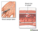 Blood clots