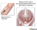 Retinal dye injection