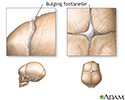 Bulging fontanelles